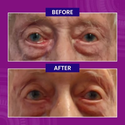 Right Eye Ectropian Repair 1 700x700 1