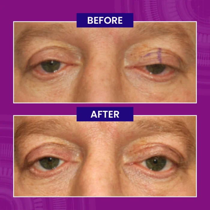 Unilateral Ptosis - first post op Unilateral Ptosis first post op